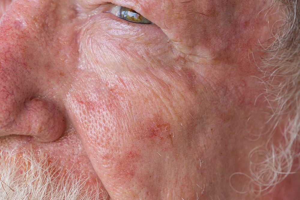 Old man needing treatment for basal cell carcinoma