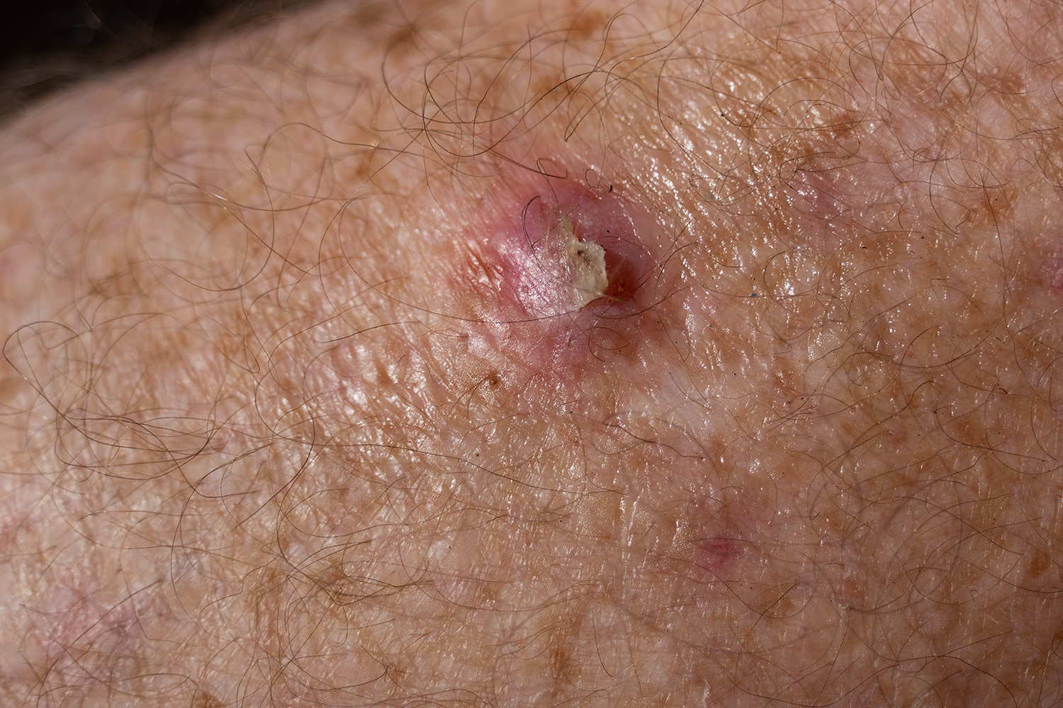 SCC skin cancer on senior males' leg