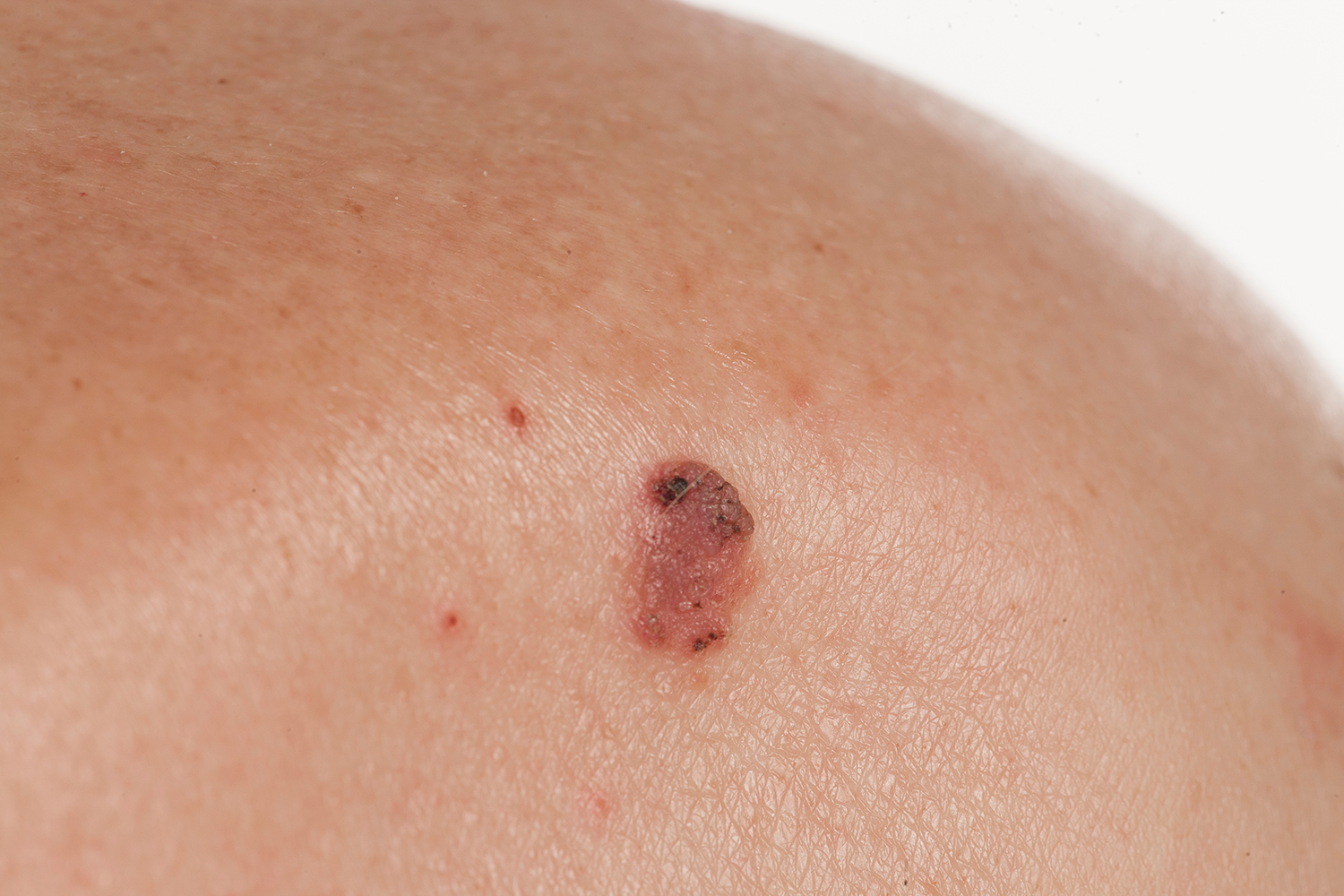 squamous cell carcinoma of the skin